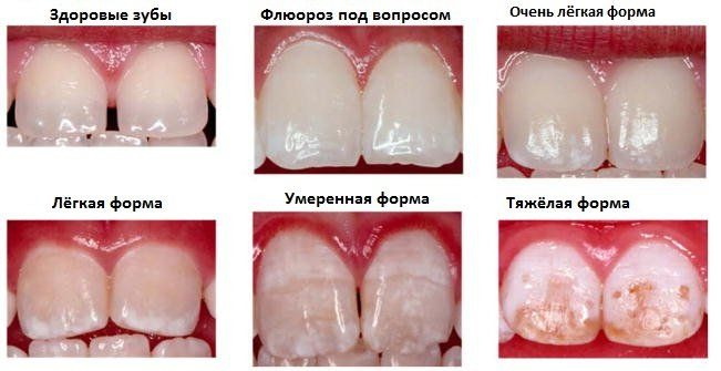 Шкала Вита цветов зубов. Фото, оттенки по номерам