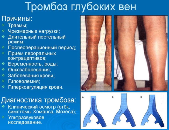 Симптомы Хоманса и Мозеса: что это, признаки, заболевания