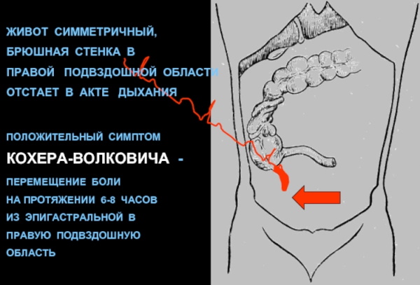 Симптом Кохера при аппендиците. Что это, механизм возникновения