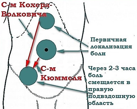 Симптом Кохера при аппендиците. Что это, механизм возникновения