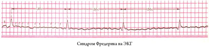 Синдром фредерика на экг фото