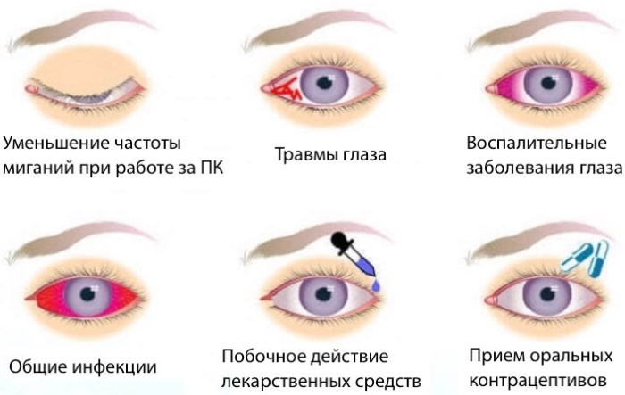 Сухость в глазах. Причины и лечение, капли