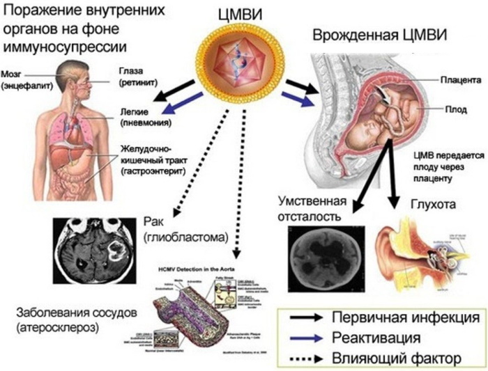 Цитомегаловирус. Лечение у женщин, препараты, схема