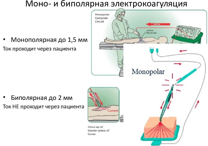 Удаление родинок электрокоагуляцией. Чем и как обрабатывать рану