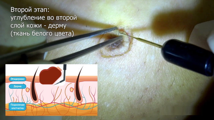 Удаление родинок электрокоагуляцией. Чем и как обрабатывать рану