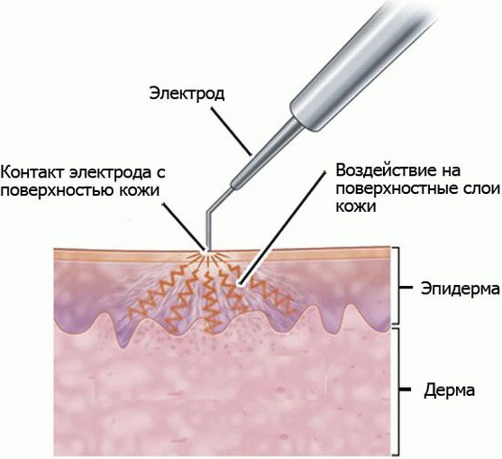 Удаление родинок электрокоагуляцией. Чем и как обрабатывать рану