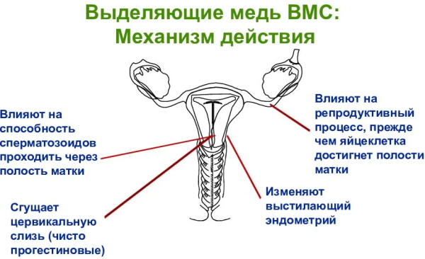 ВМС (внутриматочная спираль) в гинекологии. Фото, какая лучше, плюсы и минусы