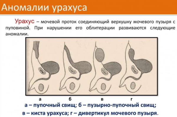 Запах из пупка у женщины. Причины и лечение