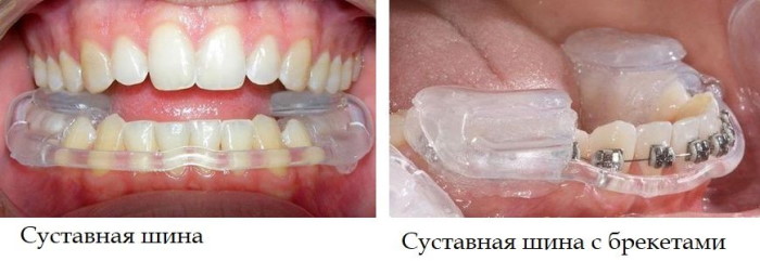 Дисфункция височно-нижнечелюстного сустава. Симптомы и лечение