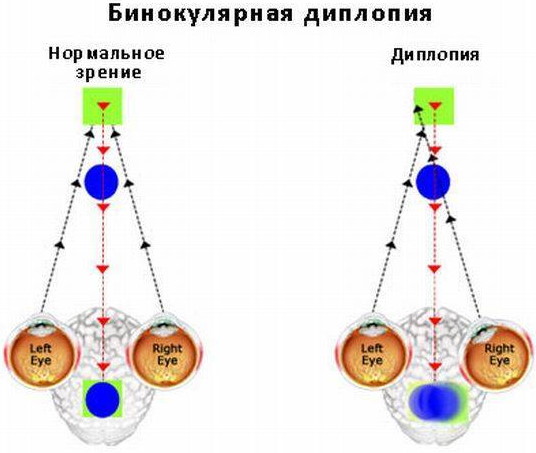 Двоится в глазах при взгляде вдаль. Причины