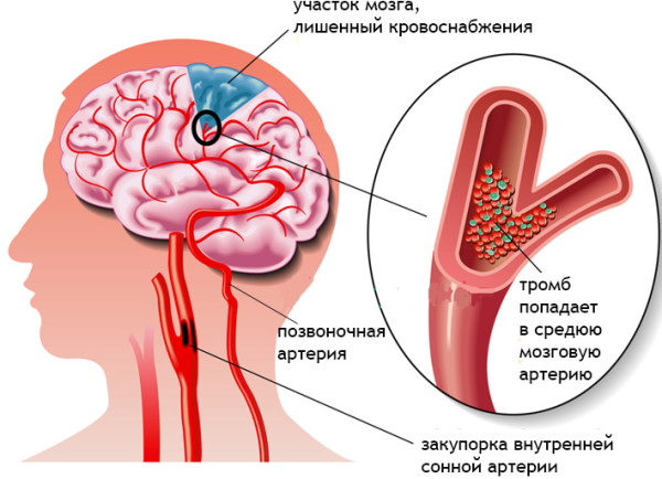 Горметония, горметонический синдром Давиденкова. Неврология