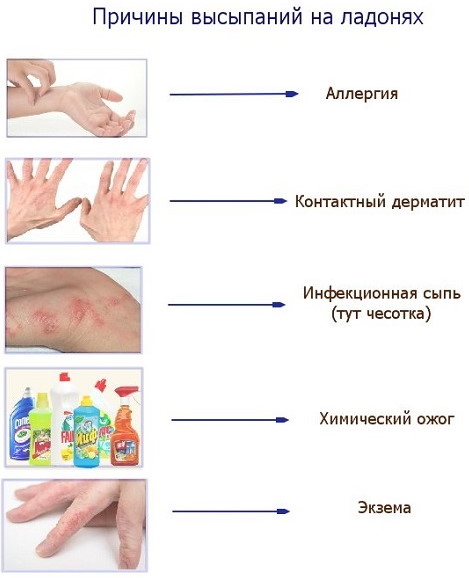 Красные ладошки у ребенка, красные пятна, точки. Причины