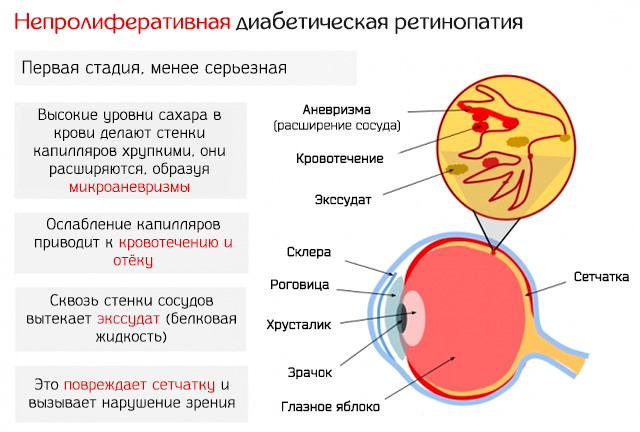 Перед глазами плавают черные ниточки, мушки, точки