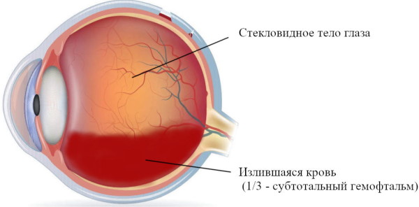 Перед глазами плавают черные ниточки, мушки, точки