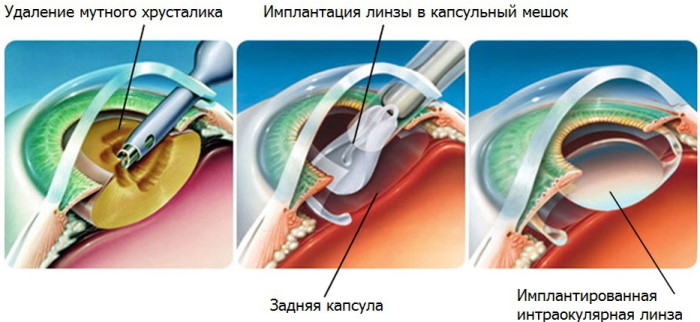 Перед глазами плавают черные ниточки, мушки, точки