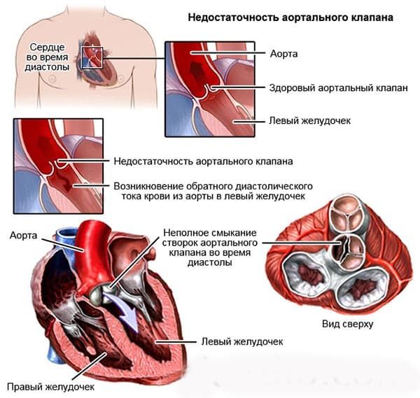 Перед глазами плавают черные ниточки, мушки, точки