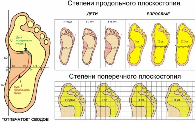 Плоскостопие 2 степени: категория годности в армию, лечение