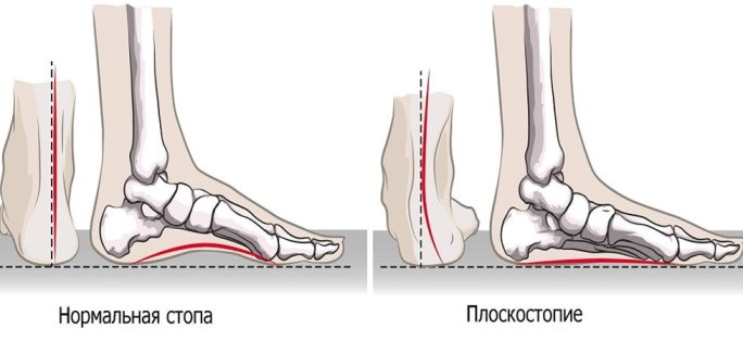 Плоскостопие 2 степени: категория годности в армию, лечение