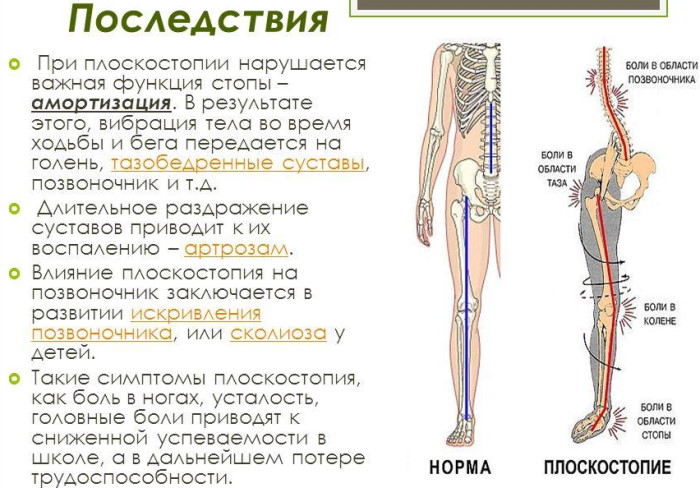 Плоскостопие 2 степени: категория годности в армию, лечение