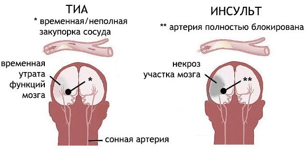 Кружится голова при повороте, лежа и при вставании. Причины