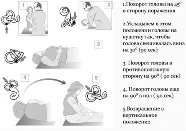 Кружится голова при повороте, лежа и при вставании. Причины