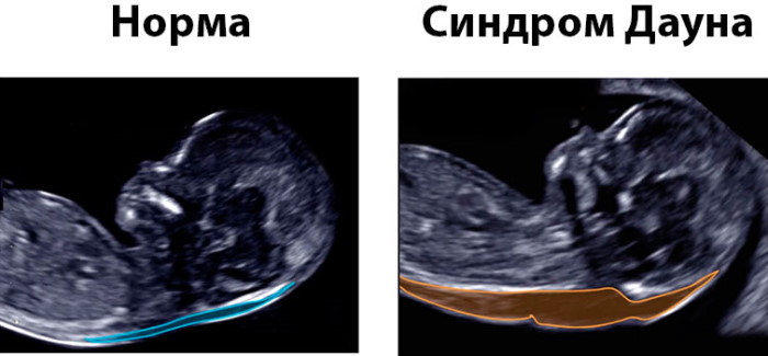 Риск трисомии 21 в 1 м триместре. Что это значит у беременных