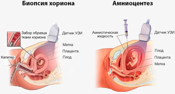 Риск трисомии 21 в 1 м триместре. Что это значит у беременных