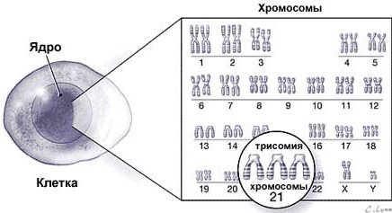 Риск трисомии 21 в 1 м триместре. Что это значит у беременных