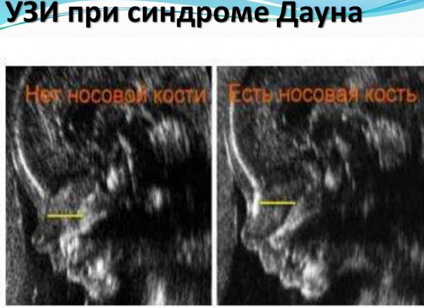 Риск трисомии 21 в 1 м триместре. Что это значит у беременных