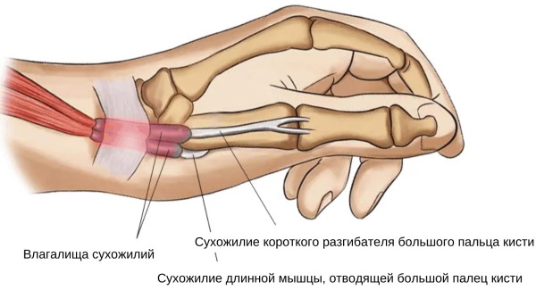 Синдром Де Кервена. Лечение медикаментозное, лазером, Дарсонваль