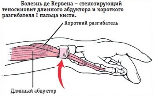 Синдром Де Кервена. Лечение медикаментозное, лазером, Дарсонваль