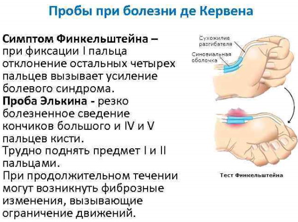 Синдром Де Кервена. Лечение медикаментозное, лазером, Дарсонваль