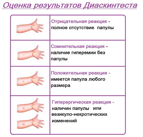 Синяк после диаскинтеста фото