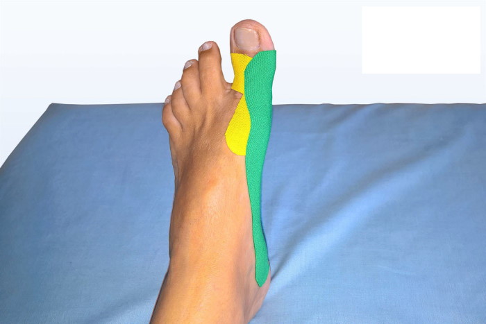 Тейпирование при вальгусной деформации стопы у детей. Схема