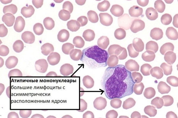 Атипичные лимфоциты в анализе крови у ребенка. Что это значит