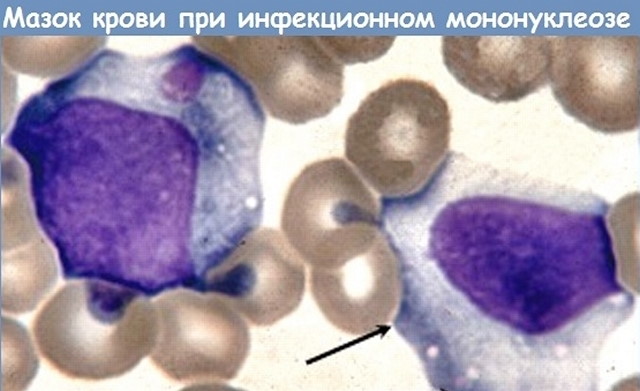 Атипичные лимфоциты в анализе крови у ребенка. Что это значит