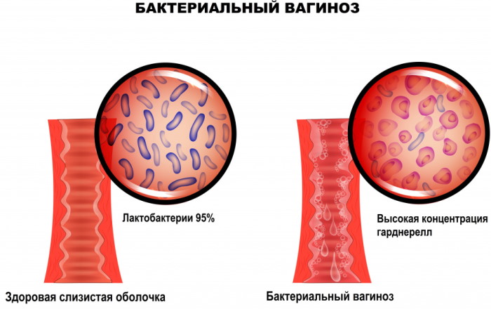 Бактериальный вагиноз. Лечение, симптомы, что это такое