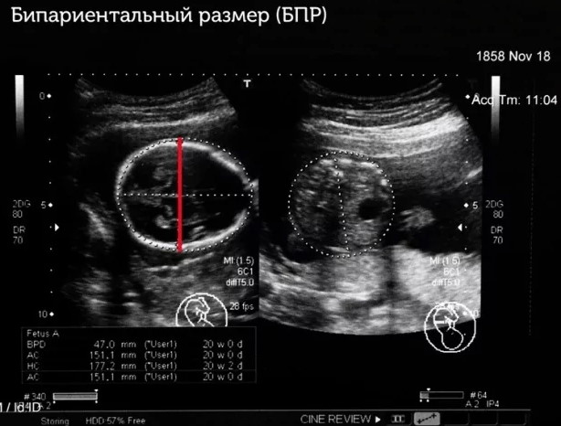 Бипариетальный размер головы по неделям (БПР головки плода) при беременности