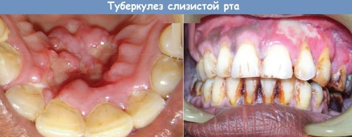 Болезни полости рта и зубов. Фото, причины и лечение