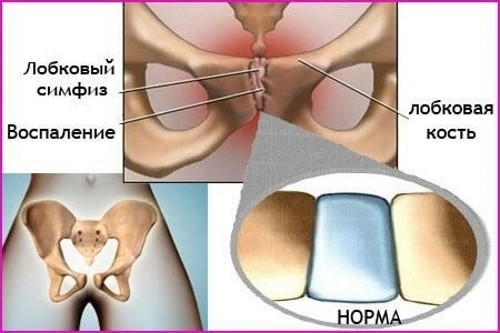 Болит лобок при беременности. Почему сильно болит по неделям