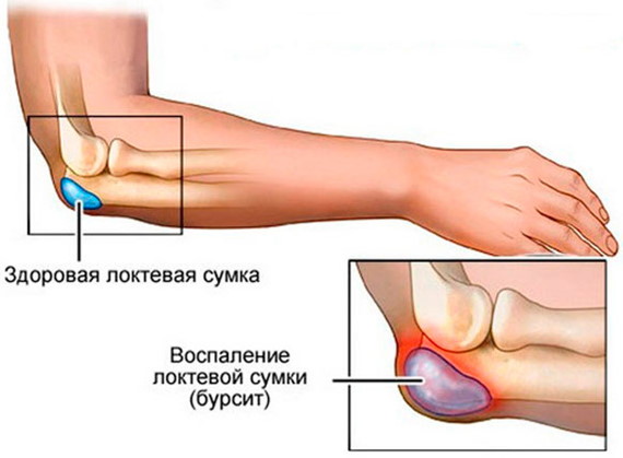 Болит локоть в суставе при нагрузке. Причины, лечение