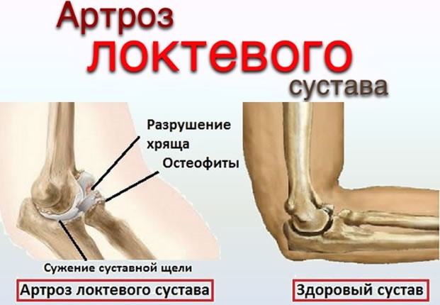 Болит локоть в суставе при нагрузке. Причины, лечение