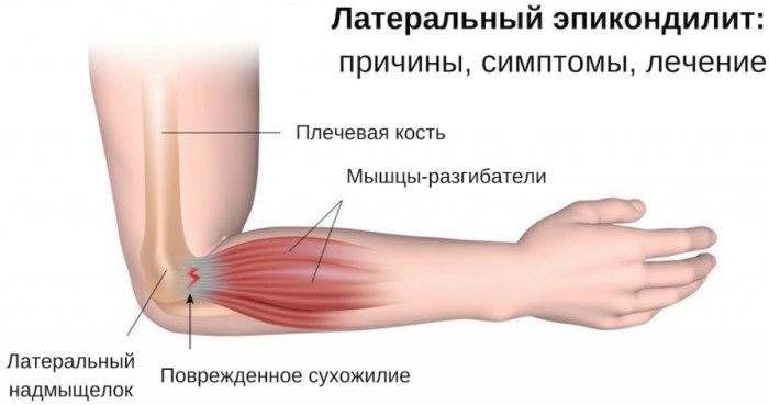 Болит локоть в суставе при нагрузке. Причины, лечение