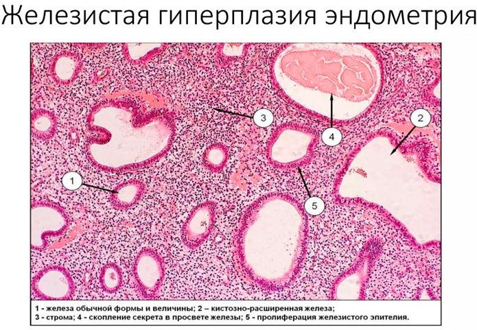 Эндометрий при менопаузе. Норма толщины