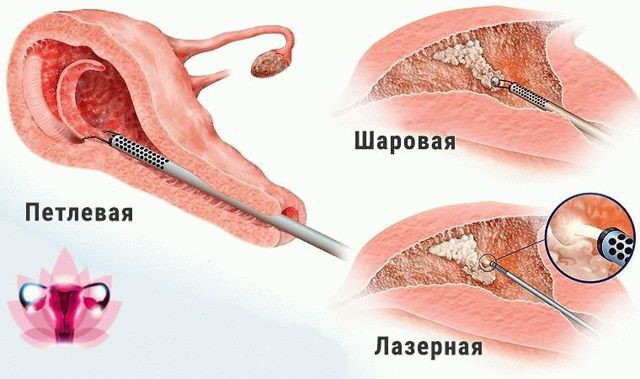 Эндометрий при менопаузе. Норма толщины