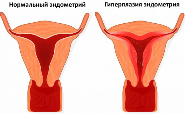 Эндометрий при менопаузе. Норма толщины