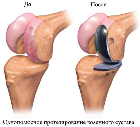 Эндопротезирование коленного сустава. Цена, реабилитация