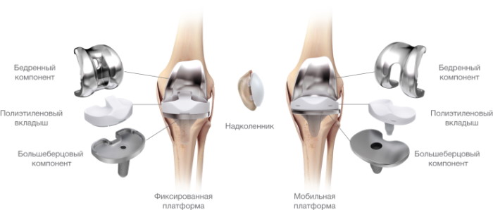 Эндопротезирование коленного сустава. Цена, реабилитация