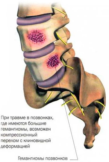 Гемангиома l2 позвонка фото