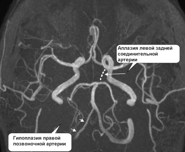 Гипоплазия правой позвоночной артерии. Что это, симптомы, лечение